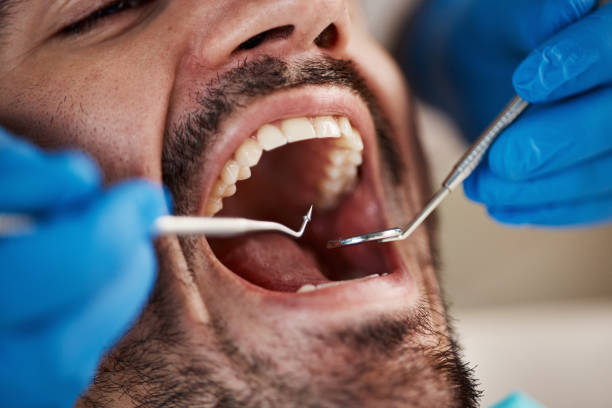 Best Emergency Tooth Extraction in Bard College, NY